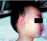 発疹（国立感染症研究所参照）の写真