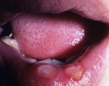 唇の病変の写真