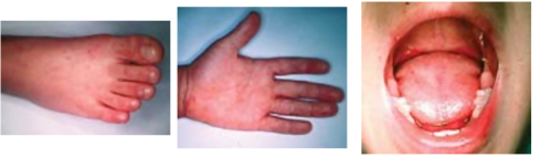 手足口病における水疱性発疹の画像（画像出典：国立感染症研究所）